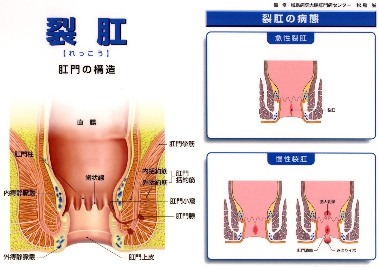 裂肛.jpg